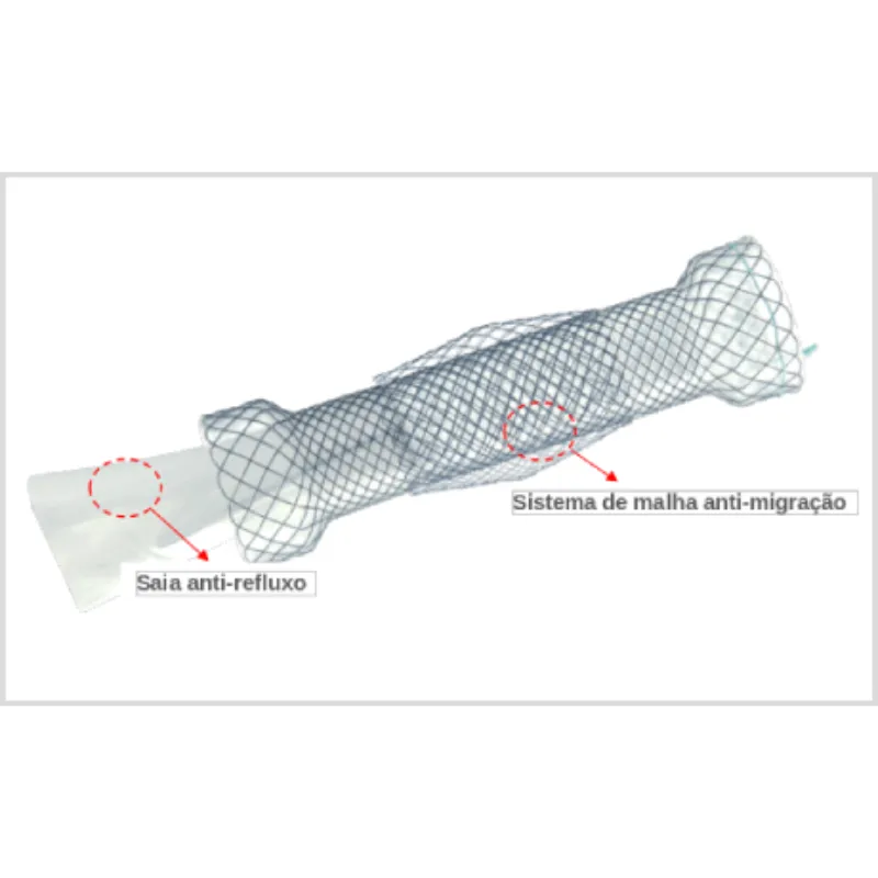Stent Esofágico DOUBLE anti-refluxo